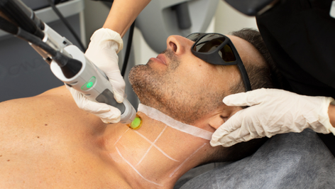 إزالة الشعر - 